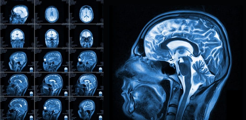 ct scan evidence latent aneurysm